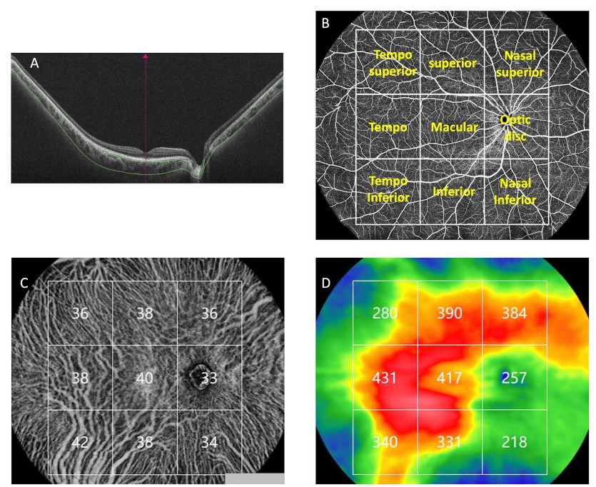 toward_pi's tweet photo. A recent study published in BMJ Open Ophthalmology evaluated choroidal vascular changes in younger patients with #myopia using #TowardPi's ultrawide-field (UWF) full-range swept-source OCTA (#SSOCTA).
Link to the article: https://t.co/DpNpfDPpO2
#ophthotwitter #sweptsourceOCT https://t.co/FwsmVG7p0A