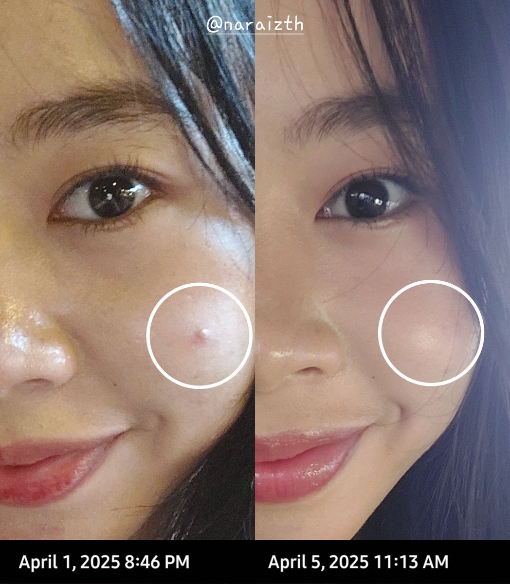 naraizth's tweet photo. cuma pake obat totol "bee clear extra formula" punya @Adara_ID jerawat bener² gone hampir ga berbekas 🥹 #Letsbeeclear
JUJUR INI BAGUS POL..😭🧎🏻♀️🧎🏻♀️
udah mah works, isinya banyak tp cuma 30 ribuan aja, BEST DEAL🤝🏻 https://t.co/zKOAu4fFH0