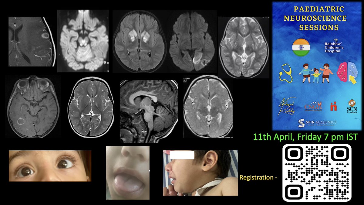 Nihaal Reddy (@nihaal08) on Twitter photo 📢 Today 🇮🇳 Pediatric Neuroradiology-Neuroscience Grand Rounds in collab with <a href="/spinacademics/">SPIN | Society of Pediatric Neuroimaging</a> <a href="/RCH_India/">Rainbow Children's Hospitals</a>
Scan the Qr for one time registration and see you at 7 pm IST.. 🧠 ❤️ 🙂
#pedineurorad #pedsneurorad #pedsneuro #neuroradiology 📢 Today 🇮🇳 Pediatric Neuroradiology-Neuroscience Grand Rounds in collab with <a href="/spinacademics/">SPIN | Society of Pediatric Neuroimaging</a> <a href="/RCH_India/">Rainbow Children's Hospitals</a>
Scan the Qr for one time registration and see you at 7 pm IST.. 🧠 ❤️ 🙂
#pedineurorad #pedsneurorad #pedsneuro #neuroradiology