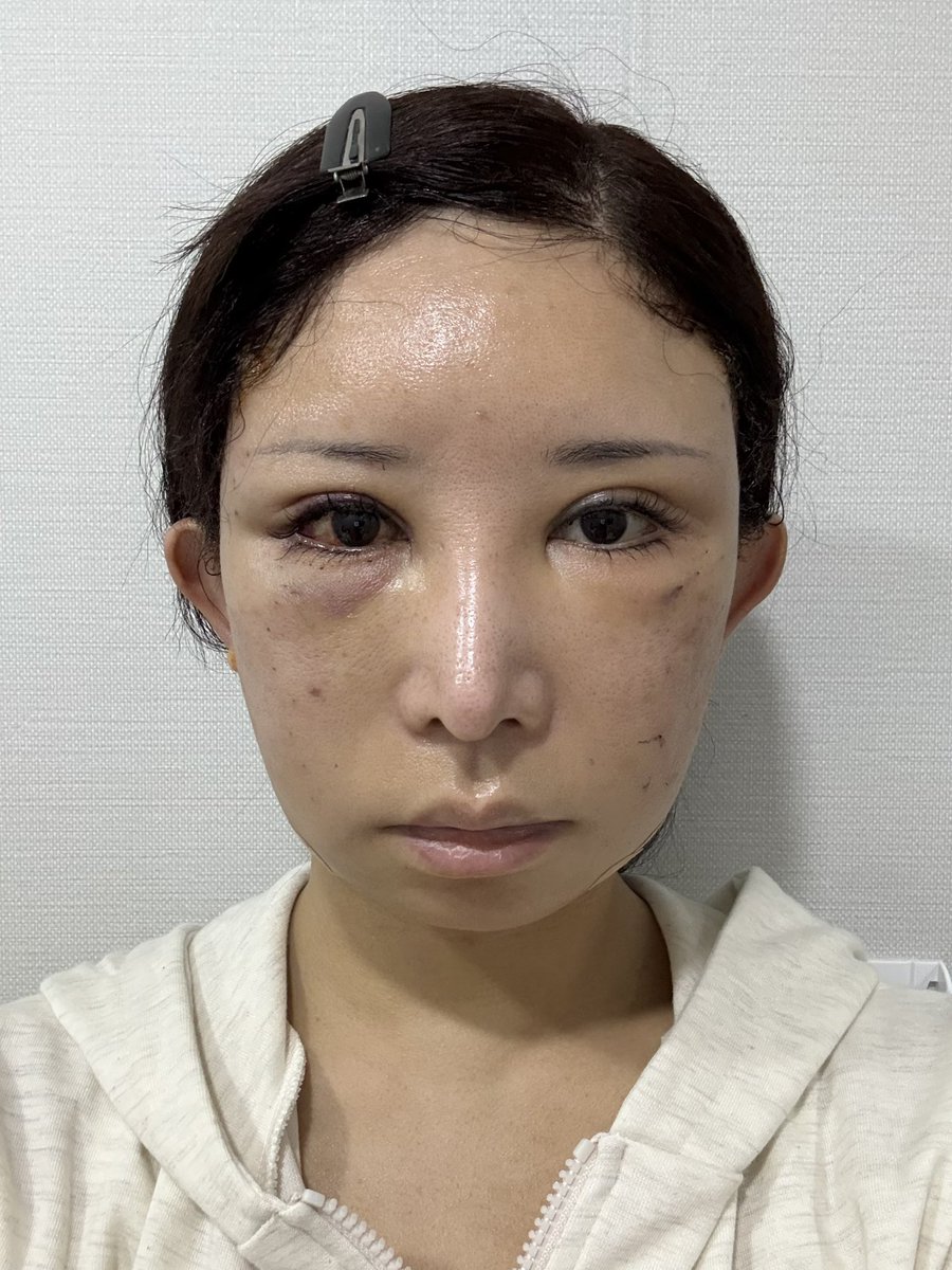 an20230422's tweet photo. 【術後1日目⇒2日目】

1枚目⇒圧迫バンドを外した直後
2枚目⇒2日目の夕方

腫れが下にさがって目が開くようになってきました(⁎⁍̴̛ᴗ⁍̴̛⁎)
 
それにしても髪型ヤバい🤣笑

#セミン整形外科 #整形垢 #韓国整形 
#切開リフト #フェイスリフト

@seminpsjapan https://t.co/MzjW9yU9ap