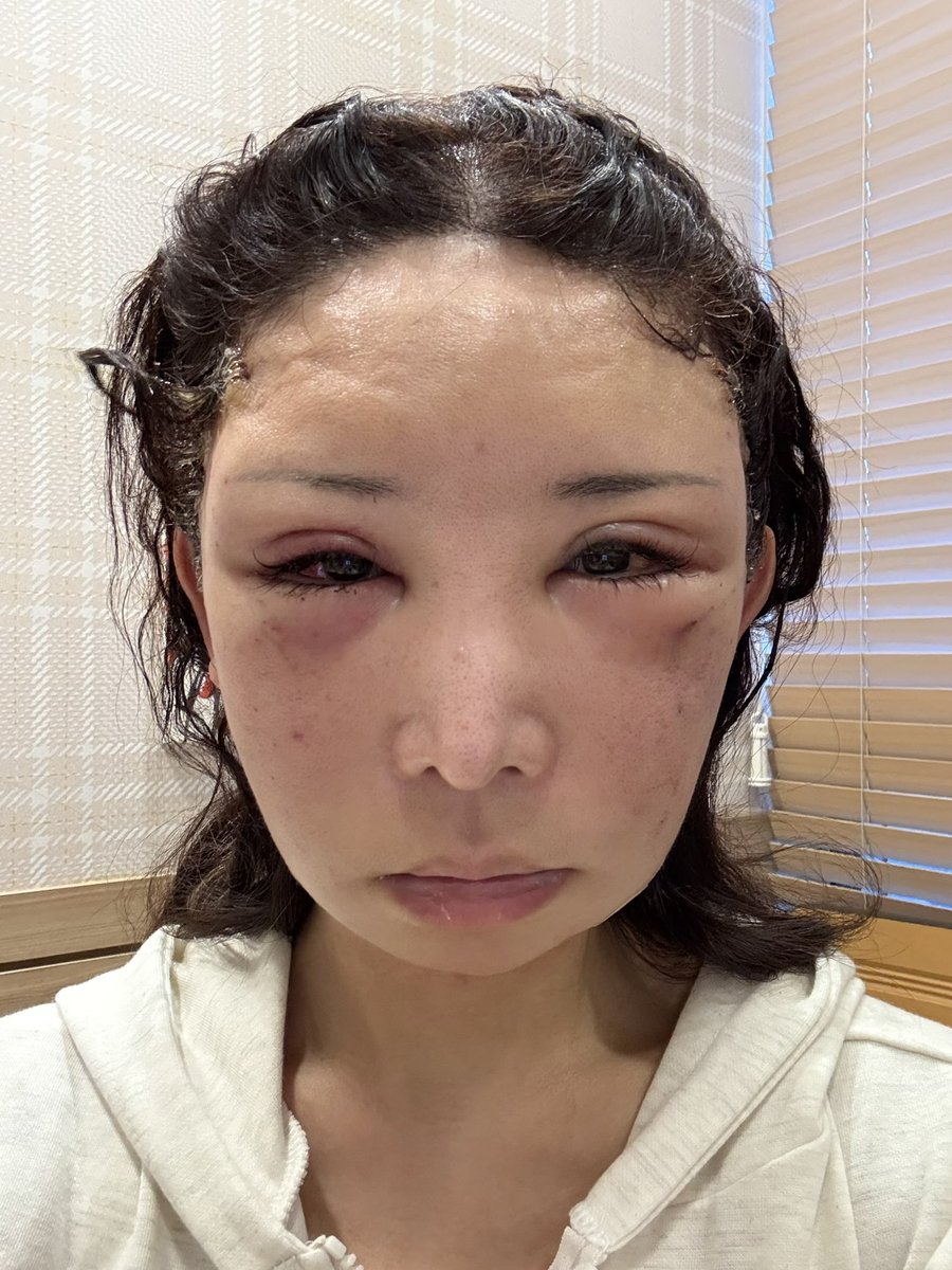 an20230422's tweet photo. 【術後1日目⇒2日目】

1枚目⇒圧迫バンドを外した直後
2枚目⇒2日目の夕方

腫れが下にさがって目が開くようになってきました(⁎⁍̴̛ᴗ⁍̴̛⁎)
 
それにしても髪型ヤバい🤣笑

#セミン整形外科 #整形垢 #韓国整形 
#切開リフト #フェイスリフト

@seminpsjapan https://t.co/MzjW9yU9ap