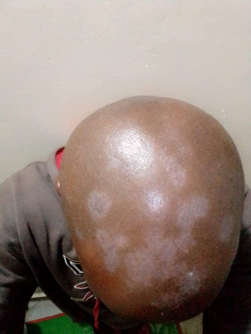 JosephAboket's tweet photo. What could be the cause and treatment for this?,@ArunInamadar @Doctors__squad @drkeithsiau https://t.co/4X0hRPw2b6