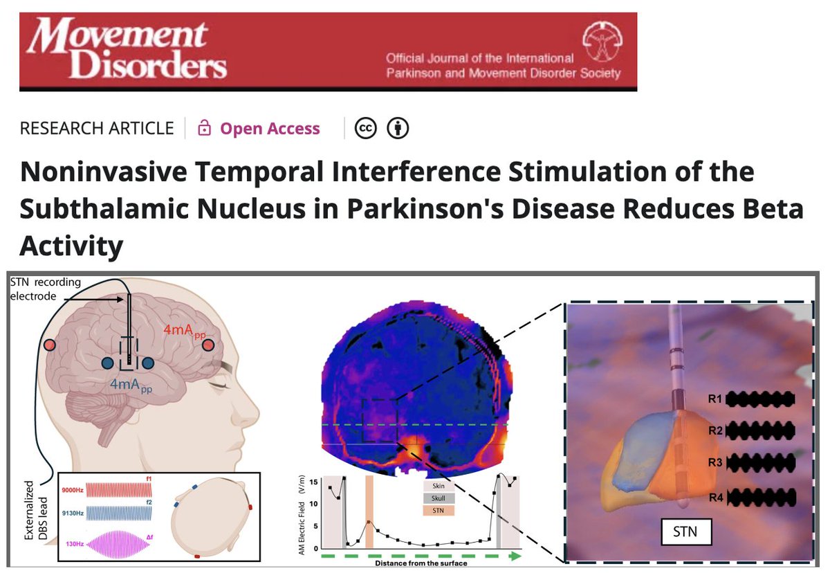 Are we getting closer to noninvasive temporal interference stimulation instead of DBS? Maybe? DBS has been such an effective Parkinson's therapy, that as we seek citius, altius, fortius; the swifter, higher and stronger approaches, we realize that the mountain is quite steep.