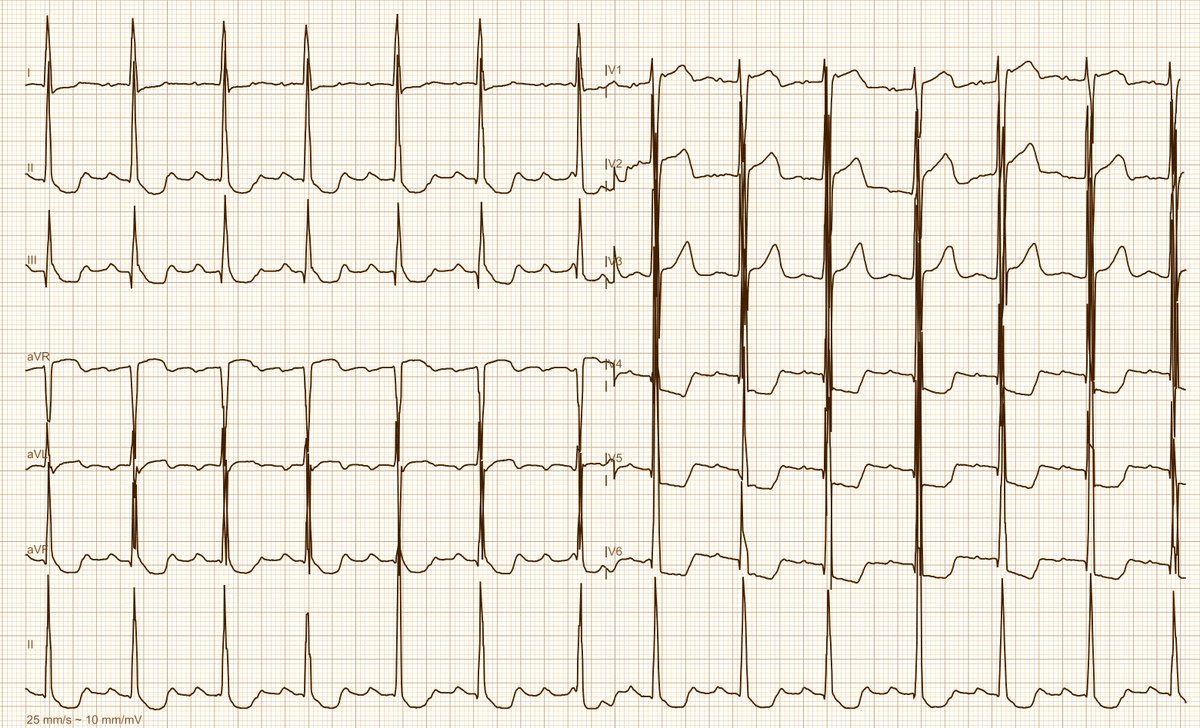 Andreas Roeschl, MD (@ecgandrhythmroe) on Twitter photo Another ECG from the Reddit community; the patient probably has chest pain; what do you think? Another ECG from the Reddit community; the patient probably has chest pain; what do you think?