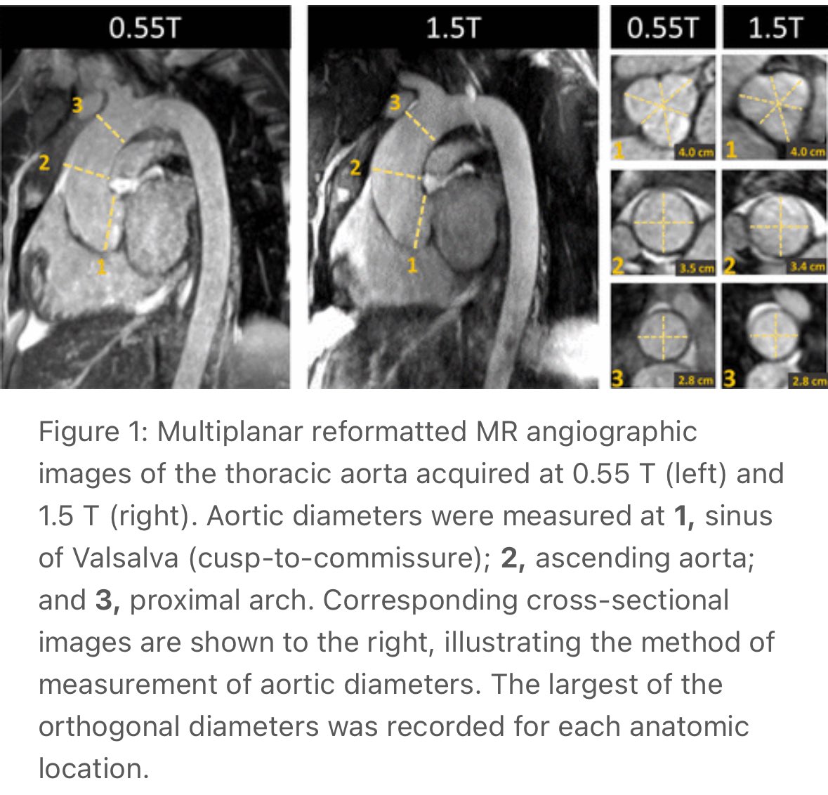 Low-field win: 0.55T non-contrast 3D MRA = non-inferior to 1.5T
🙏Great option for patients with severe obesity, claustrophobia or metallic artifacts - and easier on the budget

pubs.rsna.org/eprint/GQYVWIR…
