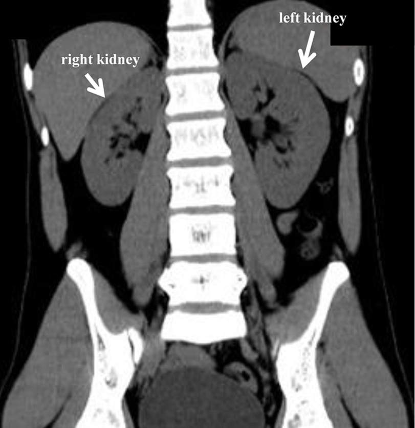 Differentiating Between Fibromuscular Dysplasia and Takayasu Arteritis in a Patient With Juvenile #RenovascularHypertension and Marked Hypokalemia Effectively Treated With Percutaneous Transluminal Renal Angioplasty
jocmr.elmerjournals.com/jocmr/article/…