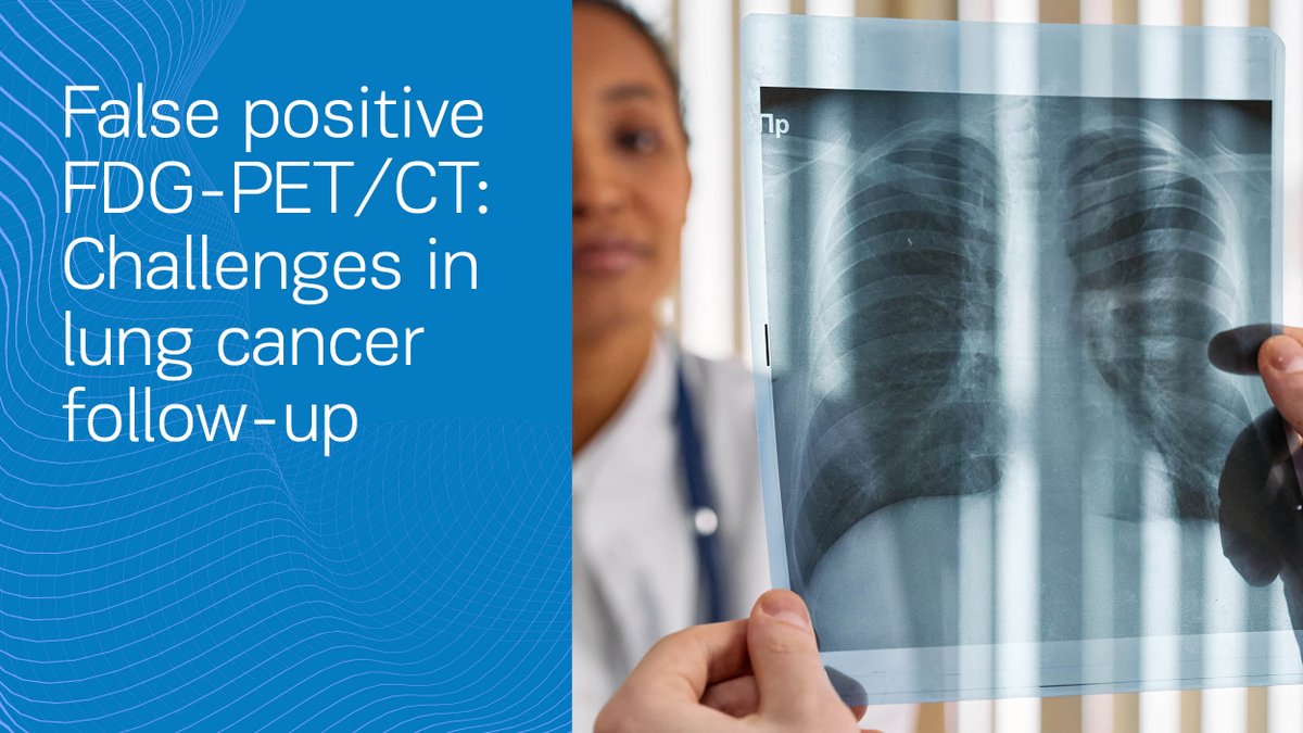 PneumonJ's tweet photo. A 54-year-old woman in remission faced a false positive on #FDG-PET/CT imaging, raising questions about #surveillanceprotocols in lung #cancer management.
- By Vakouftsi CA et al
- @Pneumon - @EurPublishing 
DOI: https://t.co/ZeiYSWpNmD https://t.co/poER0wIGeS