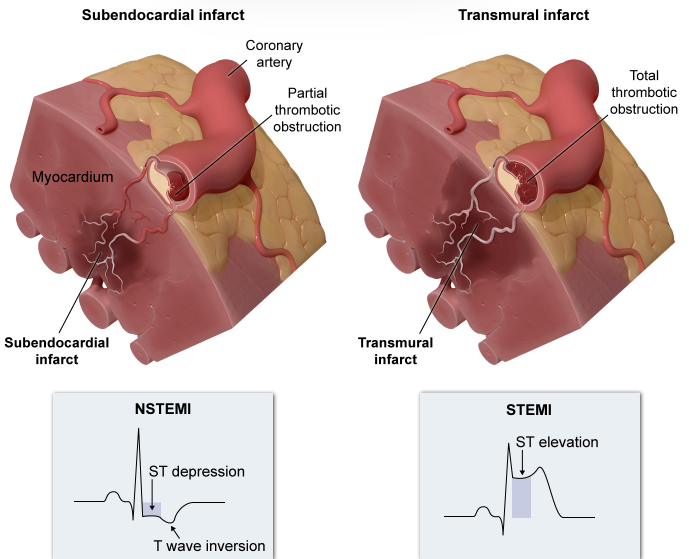 NSTEMI  Vs  STEMI