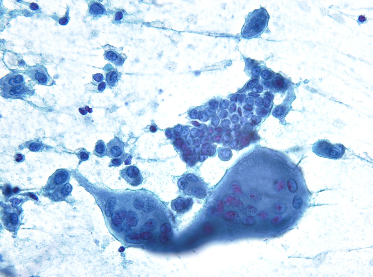 sza_jhcyto's tweet image. &quot;Multinucleated giant histiocytes&quot; are not rare in FNAs of Papillary Thyroid Carcinoma and should not be overinterpreted as pleomorphic tumor giant cells.
