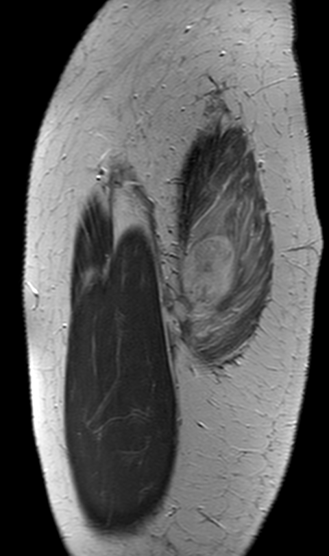 MSK Teaching Room (@mskteachingroom) on Twitter photo h/o trauma π€
#FOAMrad #FOAMed #radres #orthotwitter
<a href="/SidThakerMSK/">Siddharth Thaker (Thee/Thou/Thine)</a> <a href="/jacja_/">JJ</a> <a href="/veronica_giotas/">Veronica Giotas (Attard)</a> h/o trauma π€
#FOAMrad #FOAMed #radres #orthotwitter
<a href="/SidThakerMSK/">Siddharth Thaker (Thee/Thou/Thine)</a> <a href="/jacja_/">JJ</a> <a href="/veronica_giotas/">Veronica Giotas (Attard)</a>