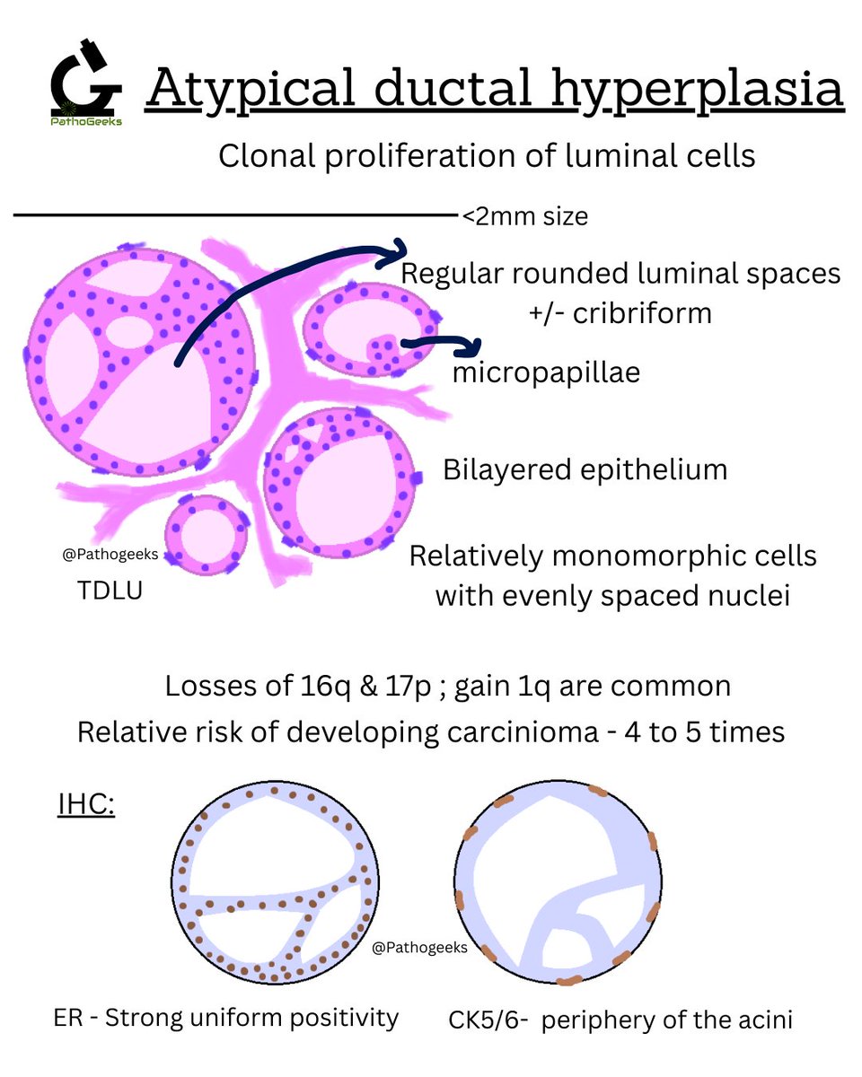 Pathogeeks's tweet photo. Breast series - 1
Quick snippet on differentiating UDH from ADH.
More content coming up. 
#pathx #pathtwitter #pathology #pathologynotes https://t.co/01vqnYaxcc