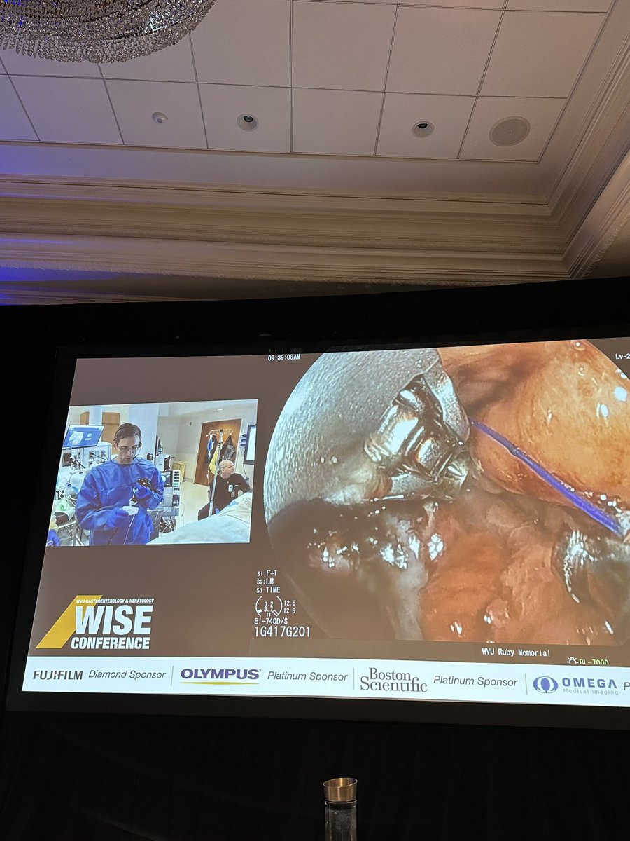 Mohammad Bilal, MD (@bilalmohammadmd) on Twitter photo The one & only <a href="/MetabolicEndo/">Chris Thompson, MD</a> masterfully demonstrating complex fistula closure using #ESD & #Suturing
✳️ ESD first
✳️ APC 🔥
✳️ Suturing
#WISE2025 <a href="/ShyamTMD/">Shyam Thakkar, MD</a> <a href="/shailsingh/">Shailendra Singh</a> The one & only <a href="/MetabolicEndo/">Chris Thompson, MD</a> masterfully demonstrating complex fistula closure using #ESD & #Suturing
✳️ ESD first
✳️ APC 🔥
✳️ Suturing
#WISE2025 <a href="/ShyamTMD/">Shyam Thakkar, MD</a> <a href="/shailsingh/">Shailendra Singh</a>