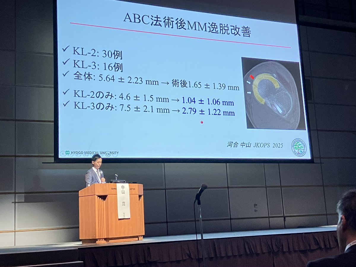 hiroshi0273's tweet photo. ランチョンセミナー🦵

#日本kneeosteotomyandjointpreservation研究会 
#jkops 

#40センチから片足で立てる様に
#半月板切除はお控えください
#arthroscopicbeltcapsulodesis 
#meniscotibialligament 
#内側半月板逸脱 
#abc法 
#半月板制動術 
#膝矯正術
#新時代のAKO https://t.co/4pNeFMhmAh