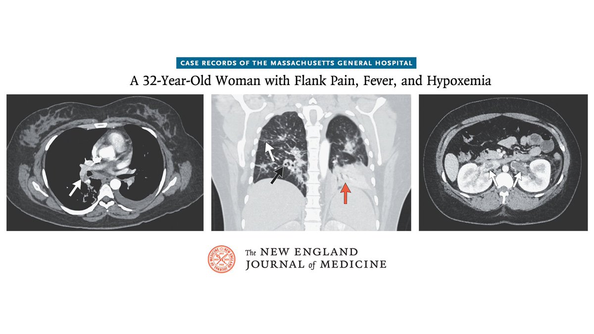 NEJM (@nejm) on Twitter photo Case Records of the Massachusetts General Hospital (<a href="/MassGeneralNews/">MassGeneral News</a>): A 32-year-old woman was admitted with flank pain, fever, and hypoxemia. Imaging showed multifocal pulmonary opacities, pulmonary embolism, and renal vein thromboses. A diagnosis was made. Read the full case Case Records of the Massachusetts General Hospital (<a href="/MassGeneralNews/">MassGeneral News</a>): A 32-year-old woman was admitted with flank pain, fever, and hypoxemia. Imaging showed multifocal pulmonary opacities, pulmonary embolism, and renal vein thromboses. A diagnosis was made. Read the full case