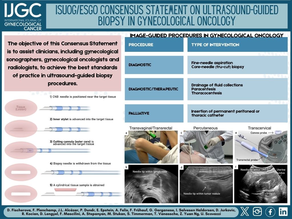IJGC (@ijgconline) on Twitter photo #SocietyStatement #ISUOG / #ESGO Consensus Statement on ultrasound-guided biopsy in #gynecologicaloncology
π bit.ly/43P3InU
<a href="/ISUOG/">ISUOG</a> <a href="/ESGO_society/">ESGO</a> <a href="/pedroramirezMD/">Pedro T Ramirez</a> <a href="/HsuMd/">Arthur_HC_Hsu</a> <a href="/JayrajAarthi/">Aarthi S Jayraj</a> <a href="/AndreFernandes2/">Andreina Fernandes</a> <a href="/IGCSociety/">IGCS</a> <a href="/OncoAlert/">OncoAlert</a> <a href="/IJGCfellows/">IJGC Fellows</a> <a href="/GynMe4/">SoMe4GynOnc</a> <a href="/thomasbartlMD/">Thomas Bartl</a> #SocietyStatement #ISUOG / #ESGO Consensus Statement on ultrasound-guided biopsy in #gynecologicaloncology
π bit.ly/43P3InU
<a href="/ISUOG/">ISUOG</a> <a href="/ESGO_society/">ESGO</a> <a href="/pedroramirezMD/">Pedro T Ramirez</a> <a href="/HsuMd/">Arthur_HC_Hsu</a> <a href="/JayrajAarthi/">Aarthi S Jayraj</a> <a href="/AndreFernandes2/">Andreina Fernandes</a> <a href="/IGCSociety/">IGCS</a> <a href="/OncoAlert/">OncoAlert</a> <a href="/IJGCfellows/">IJGC Fellows</a> <a href="/GynMe4/">SoMe4GynOnc</a> <a href="/thomasbartlMD/">Thomas Bartl</a>