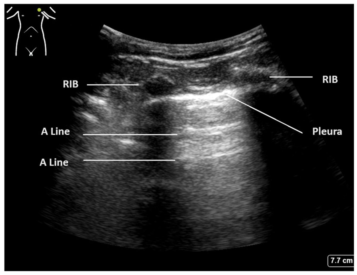#HighlyCited #Review #LungResearch 
"Lung Ultrasound in Critical Care: A Narrative Review"
👥by Lee Berry et al.

📄Access the full paper on our website: mdpi.com/2075-4418/15/6…