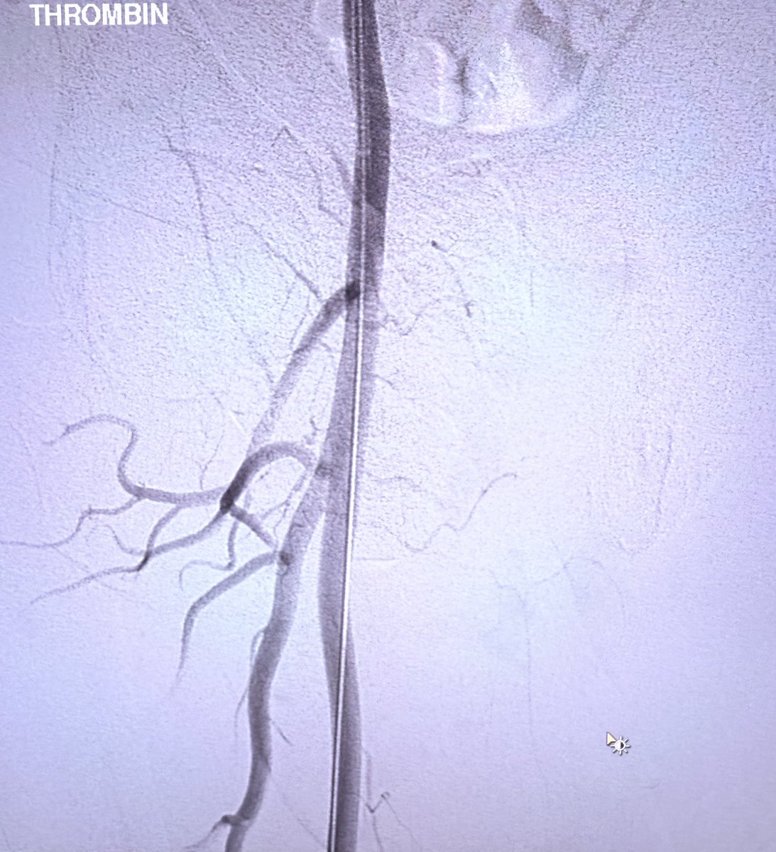 Venkat Tummala MD (@t_intheleadcoat) on Twitter photo Not sure if this qualifies for a wide neck #PSA but balloon assisted thrombin injection can save a 🔪
When do you consider it?
<a href="/farkomd/">frank arko</a> <a href="/JayMathewsMD/">Jay Mathews MD, MS, FACC, FSCAI</a> <a href="/kmadass/">Kumar Madassery</a> <a href="/LessneVIR/">Mark Lessne, MD</a> <a href="/CraigMWalkerMD/">Craig Walker, MD, FACC</a> <a href="/SDhandMD/">Sabeen Dhand</a> <a href="/keithppereira/">Keith Pereira MD, #VIrad</a> <a href="/limbsalvagedr/">Leigh Ann O'Banion</a> <a href="/roblookstein/">Robert A Lookstein MD, MHCDL</a> <a href="/saherssabri/">Saher Sabri</a> <a href="/docTPlive/">Tino Peña</a> Not sure if this qualifies for a wide neck #PSA but balloon assisted thrombin injection can save a 🔪
When do you consider it?
<a href="/farkomd/">frank arko</a> <a href="/JayMathewsMD/">Jay Mathews MD, MS, FACC, FSCAI</a> <a href="/kmadass/">Kumar Madassery</a> <a href="/LessneVIR/">Mark Lessne, MD</a> <a href="/CraigMWalkerMD/">Craig Walker, MD, FACC</a> <a href="/SDhandMD/">Sabeen Dhand</a> <a href="/keithppereira/">Keith Pereira MD, #VIrad</a> <a href="/limbsalvagedr/">Leigh Ann O'Banion</a> <a href="/roblookstein/">Robert A Lookstein MD, MHCDL</a> <a href="/saherssabri/">Saher Sabri</a> <a href="/docTPlive/">Tino Peña</a>