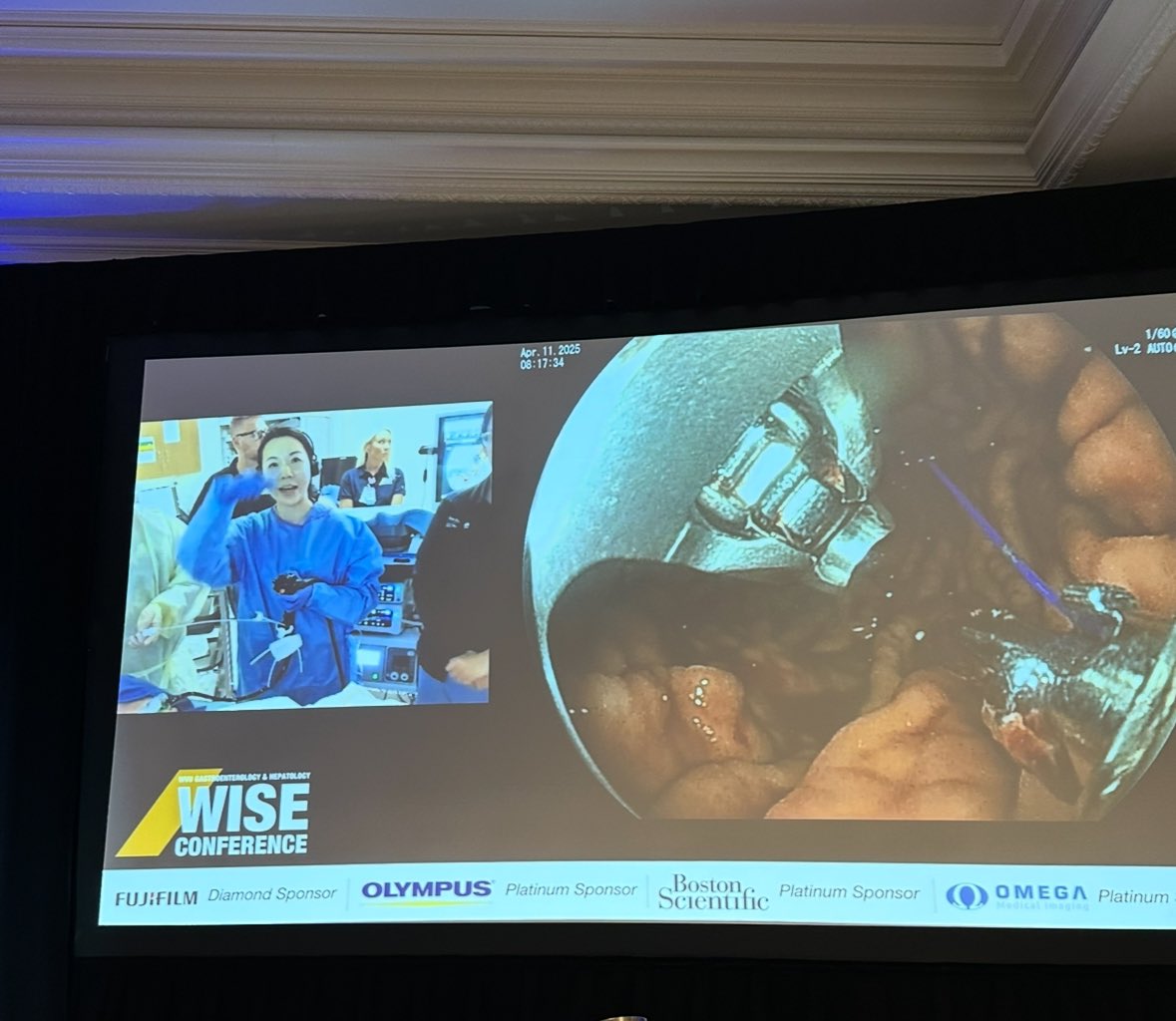 Mohammad Bilal, MD (@bilalmohammadmd) on Twitter photo The 👸 of #EndoBariatrics expertly demonstrating all things #ESG at #WISE2025
<a href="/ShyamTMD/">Shyam Thakkar, MD</a> <a href="/shailsingh/">Shailendra Singh</a> The 👸 of #EndoBariatrics expertly demonstrating all things #ESG at #WISE2025
<a href="/ShyamTMD/">Shyam Thakkar, MD</a> <a href="/shailsingh/">Shailendra Singh</a>