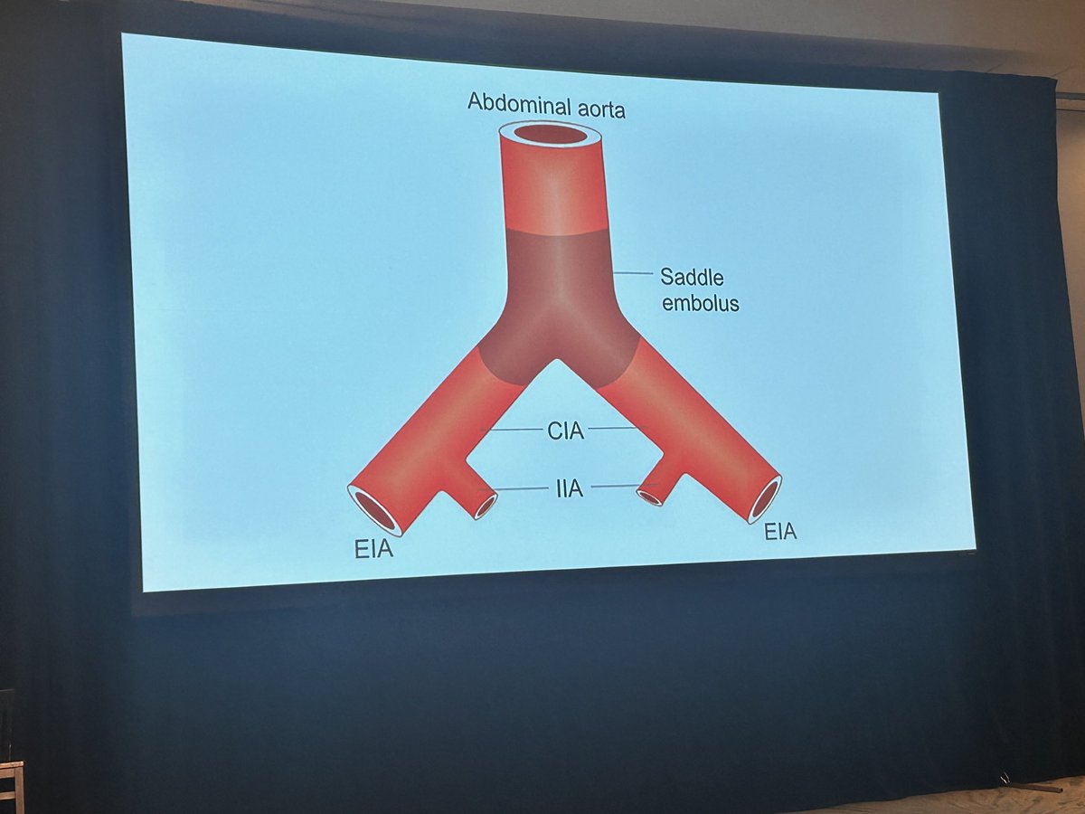 NYGH's EM Update (@em_update) on Twitter photo Sudden “cauda equina” is vascular.
Check pulses in the lower extremities.
<a href="/davidcarr333/">David Carr</a> at #EMU2025 Sudden “cauda equina” is vascular.
Check pulses in the lower extremities.
<a href="/davidcarr333/">David Carr</a> at #EMU2025