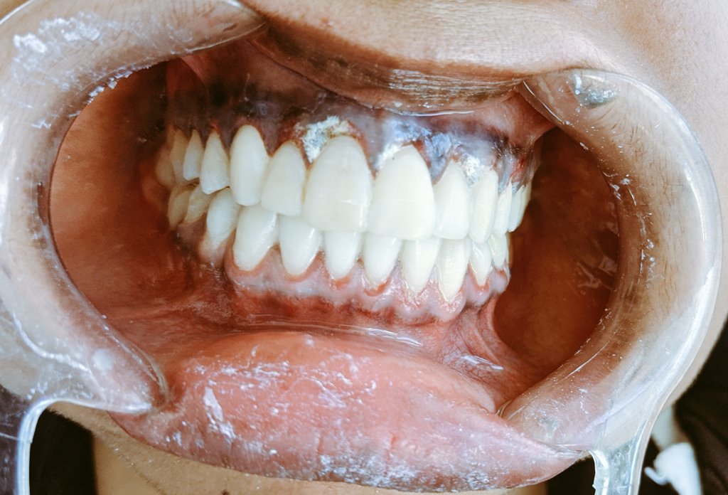 ManifaAlly's tweet photo. Blanchissement des dents https://t.co/DWCytX0MtZ