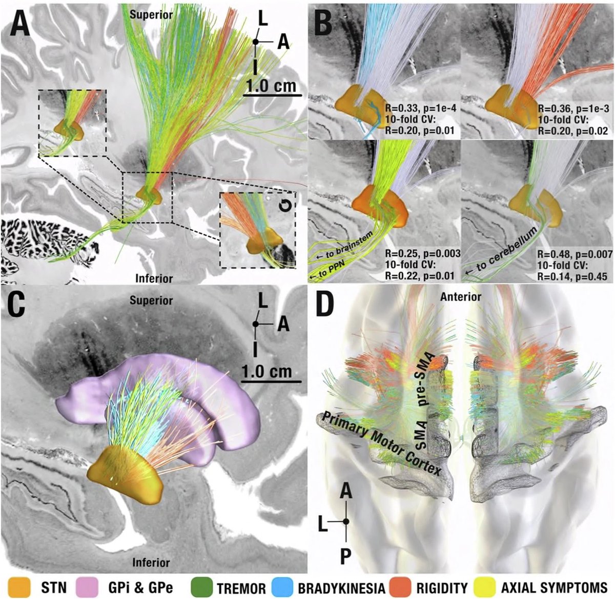￼In a recent study, Rajamani et al. mapped Parkinson’s Disease symptoms to specific white matter tracts. These findings pave the way towards personalized, symptom-guided stimulation treatment!
<a href="/AANS/">AANS</a> <a href="/CNS_Update/">CNS</a>
#ASSFN #neurosurgery 
Learn more here: 10.1038/s41467-024-48731-1