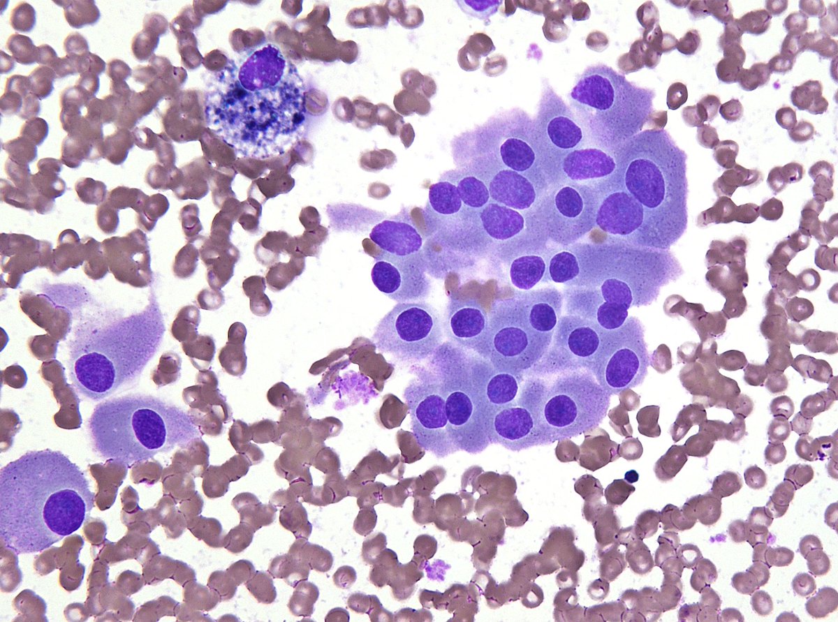 FREQUENT "binucleation" strongly favors an "oncocytic follicular neoplasm" in thyroid. (FNA)