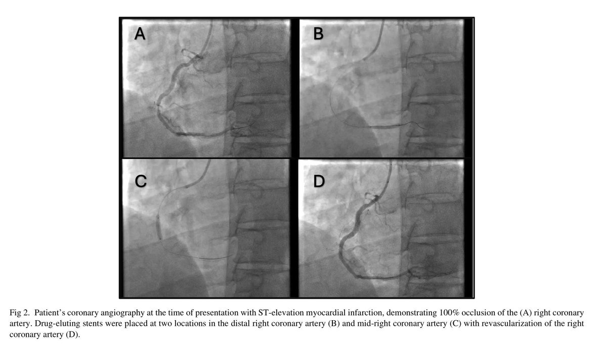 JCVAonline's tweet image. Stent Clot During Heart Surgery: A Close Call​​ ❗🩺

47yo man with heart attack got stent → needed urgent bypass 9 days later.
Stopped blood thinner 2h before surgery → ​​clot formed in stent​​ during operation.

#HeartSurgery #ClotRisk #QuickThinking 
jcvaonline.com/article/S1053-…