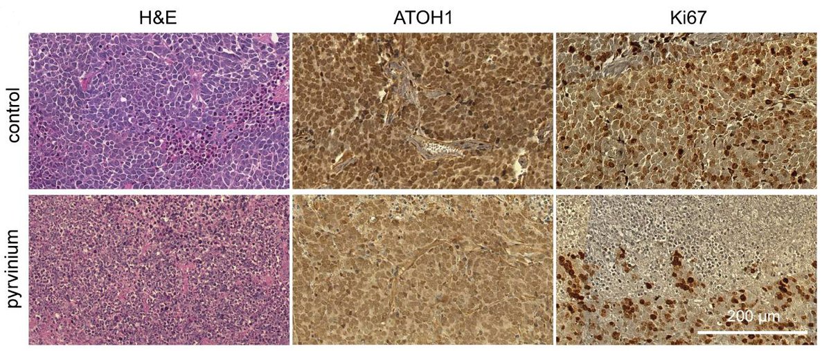 Journal of Clinical Investigation (@jclinicalinvest) on Twitter photo Merkel cell carcinoma is an aggressive neuroendocrine skin cancer with high rates of metastasis.
<a href="/megha_padi/">Megha Padi</a> & team <a href="/UAZCancer/">University of Arizona Cancer Center</a> now show pyrvinium pamoate has antitumor activity through multiple pathways in pre-clinical models:
jci.org/articles/view/… Merkel cell carcinoma is an aggressive neuroendocrine skin cancer with high rates of metastasis.
<a href="/megha_padi/">Megha Padi</a> & team <a href="/UAZCancer/">University of Arizona Cancer Center</a> now show pyrvinium pamoate has antitumor activity through multiple pathways in pre-clinical models:
jci.org/articles/view/…