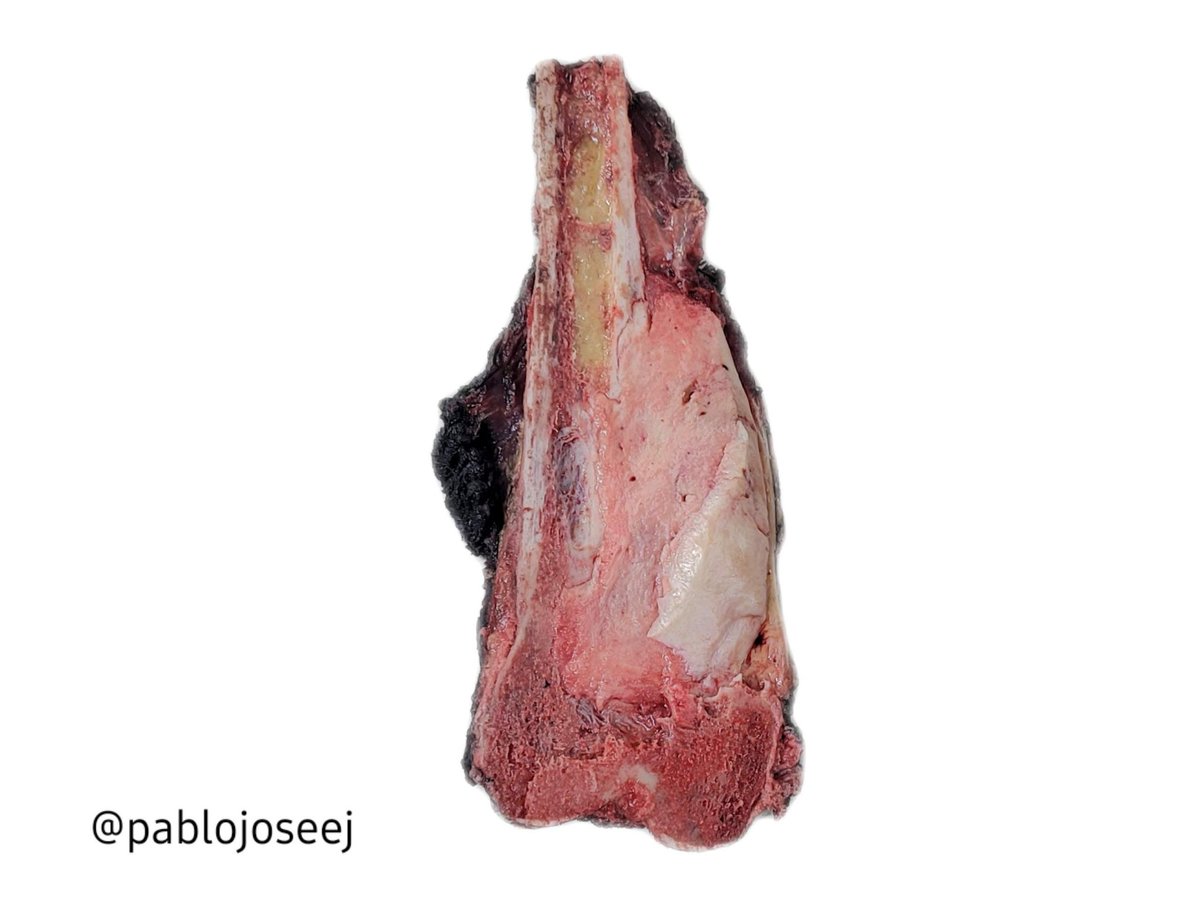 Osteosarcoma  🦴

#Pathology #AnatomiaPatologica #BSTpath 
 #Grosspathology #Grosspath #PathArt