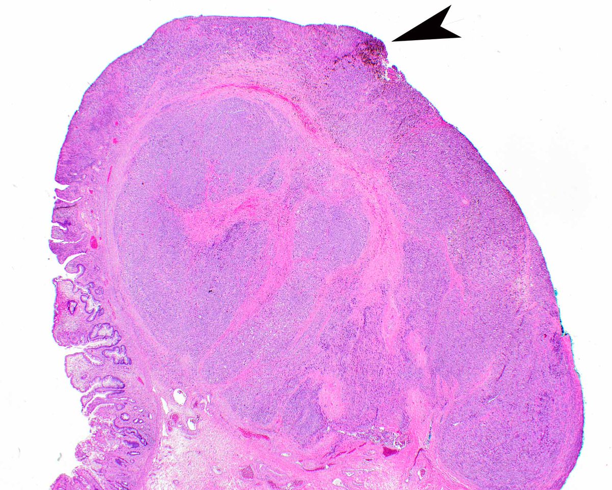 ModernPathology's tweet image. No immunohistochemical stains are needed to diagnose this anal melanoma but  Modern Pathology can help evaluate the anticipated outcome.
Nagarajan P, Piao J, Ning J, Noordenbos LE, Curry JL, Torres-Cabala CA, Diwan AH, Ivan D, Aung PP, Ross MI, Royal RE, Wargo JA, Wang WL,…