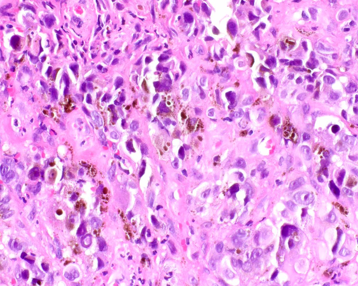 ModernPathology's tweet image. No immunohistochemical stains are needed to diagnose this anal melanoma but  Modern Pathology can help evaluate the anticipated outcome.
Nagarajan P, Piao J, Ning J, Noordenbos LE, Curry JL, Torres-Cabala CA, Diwan AH, Ivan D, Aung PP, Ross MI, Royal RE, Wargo JA, Wang WL,…
