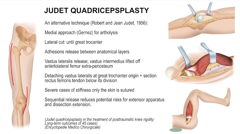 AAOS (@aaos1) on Twitter photo Celebrating the #AAOS2025 #OVT Award Winners! Modified #Judet #Quadricepsplasty for Post Traumatic #Knee Stiffness: bit.ly/43LqFs7
View this and 1700 #surgicaltechnique videos today!
<a href="/IRCCS_Rizzoli/">Rizzoli IRCCS</a>
#OVTFridays
#CME Celebrating the #AAOS2025 #OVT Award Winners! Modified #Judet #Quadricepsplasty for Post Traumatic #Knee Stiffness: bit.ly/43LqFs7
View this and 1700 #surgicaltechnique videos today!
<a href="/IRCCS_Rizzoli/">Rizzoli IRCCS</a>
#OVTFridays
#CME