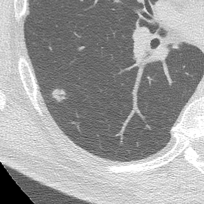 marcosmestas's tweet photo. Pulmonary nodule found on lung cancer screening CT

PET-CT at 20 days shows rapid growth (VDT 12 days) and irregular borders

Focal OP was the final diagnosis
Small nodule with very rapid growth (VDT < 40-50 days) think benign
@hochhegger @howardm19 @LaurenGroner @DanielVargasMD https://t.co/fxEe7ydAud