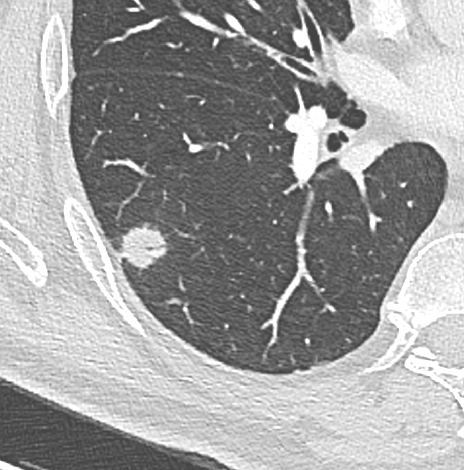 marcosmestas's tweet photo. Pulmonary nodule found on lung cancer screening CT

PET-CT at 20 days shows rapid growth (VDT 12 days) and irregular borders

Focal OP was the final diagnosis
Small nodule with very rapid growth (VDT < 40-50 days) think benign
@hochhegger @howardm19 @LaurenGroner @DanielVargasMD https://t.co/fxEe7ydAud