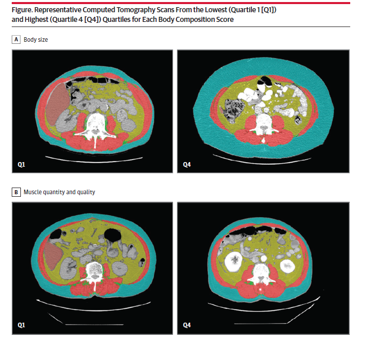 One year ago, a landmark study from <a href="/KPDOR/">Kaiser Permanente Research NorCal</a>  was published in <a href="/JAMASurgery/">JAMA Surgery</a>, leveraging DAFS Server scaled across their data center to analyze preoperative 3D abdominal CT scans from over 48,000 patients.

The findings demonstrated that automated measures of muscle quantity and