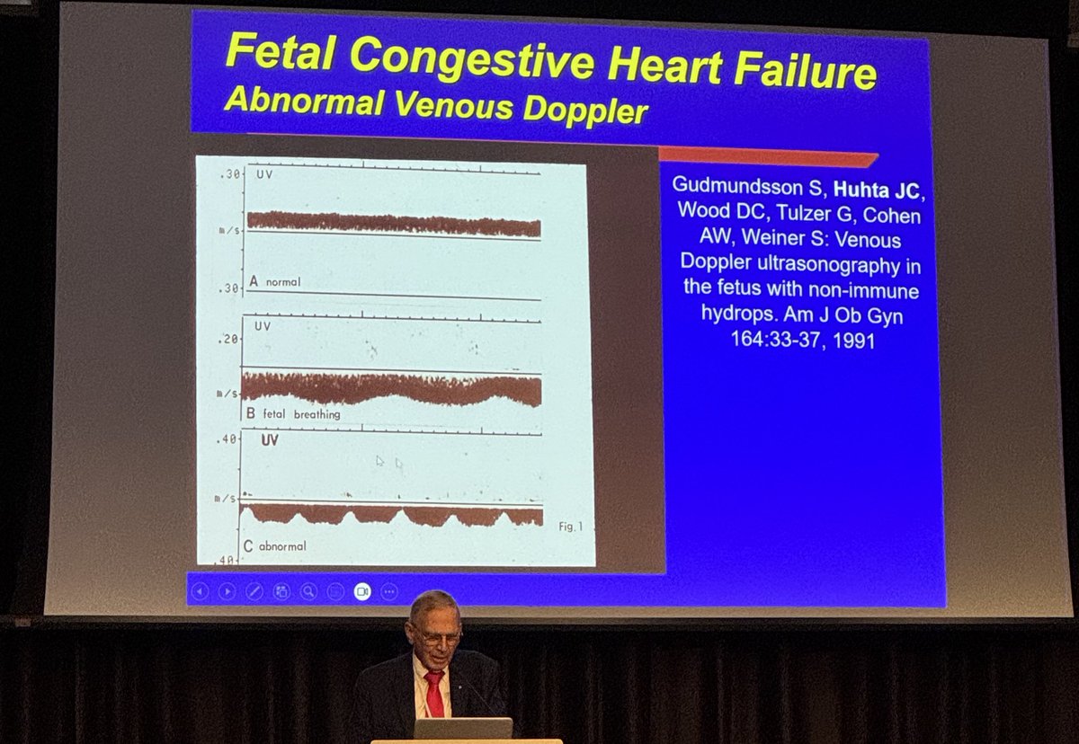 Jennifer Co-Vu, MD, FACC, FAAP, FASE (@drjenniferco_vu) on Twitter photo Speaking after one of the greats of fetal cardiology Dr. Jim Huhta is truly daunting! 😳
What a great review on fetal congestive heart failure and the CV profile scoring❤️
Thanks <a href="/AdventHealth/">AdventHealth</a> for inviting me to the FL Fetal Cardiology Symposium 2025! Speaking after one of the greats of fetal cardiology Dr. Jim Huhta is truly daunting! 😳
What a great review on fetal congestive heart failure and the CV profile scoring❤️
Thanks <a href="/AdventHealth/">AdventHealth</a> for inviting me to the FL Fetal Cardiology Symposium 2025!