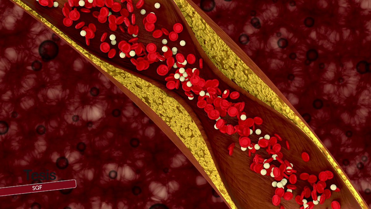 tesiscanalsur's tweet photo. 🔬 Logran un gran avance en la lucha contra el Síndrome de Quilomicronemia Familiar #SQF, una enfermedad rara que eleva peligrosamente los triglicéridos en sangre.

📺 Este sábado a las 20:00 h, #AndalucíaTV @canalsur 
👉 https://t.co/dvnRi0AFvI

#Salud #EnfermedadesRaras #CIMES https://t.co/C3HFEwDyh7