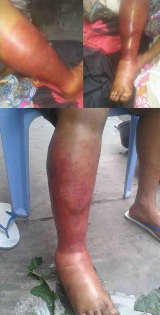 elogemwandwe's tweet photo. Aux médecins... je viens d'apprendre que le #Mbasu en français c'est l'ulcÚre de Buruli...
Une question tout de mĂȘme "quelle est la cause de cette maladie ?" Et "pourquoi en #RDC celle-ci est liĂ©e Ă une sorcellerie, qui ne peut se soigner que d'une maniĂšre mĂ©taphysique ?" https://t.co/uKIrw1QJCY