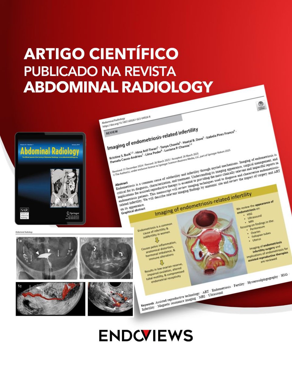 endoviews's tweet image. Compartilhamos nosso artigo sobre infertilidade relacionada à endometriose publicado na Abdominal Radiology, feito por equipe maravilhosa de especialistas em endometriose @Spechtkrypto @lucianachamiec1 @lp_pam_ @haatal @lpoder @izabelapiresfranco
rdcu.be/ehhyc