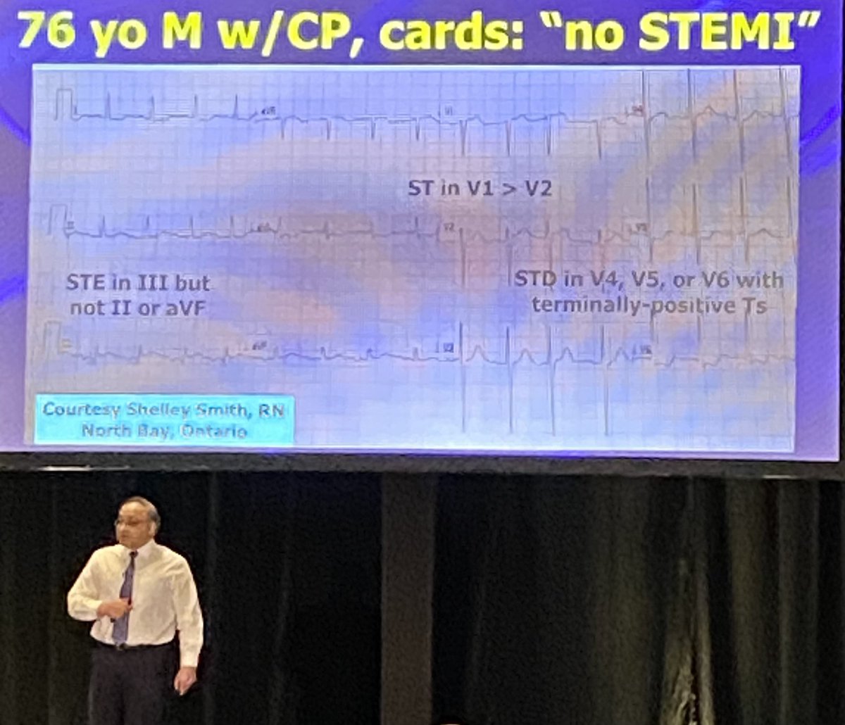 ECGcases's tweet photo. Great talk by @amalmattu at @EM_Update on cardiac emergencies, including @AslangerE pattern #EMU2025 https://t.co/uVW3obbuPN
