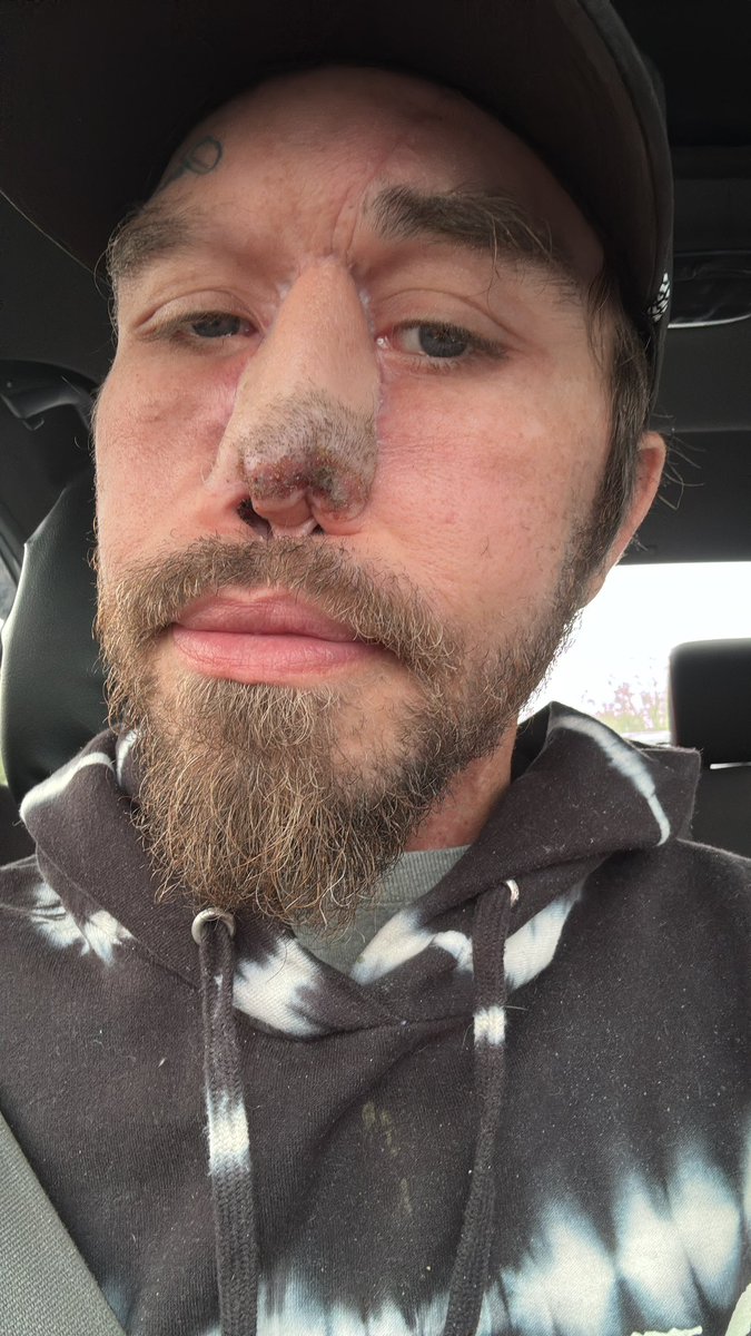 DaFeldster's tweet photo. Nose got a little burnt from the lazor removal. Few more moves and this journey should be in the bag 💼 https://t.co/W3bOkKERLq