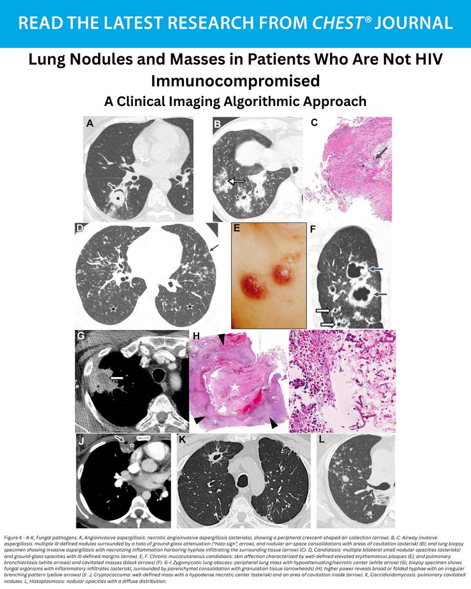 accpchest's tweet photo. A #CHESTReview presents an algorithmic approach for differentiating between various causes of pulmonary nodules &amp; masses in individuals without #HIV who are #immunocompromised, providing a valuable tool for clinical practice. Read more: https://t.co/4wuoTWGSqD
#MedTwitter #MedEd https://t.co/nYtpreqiaG