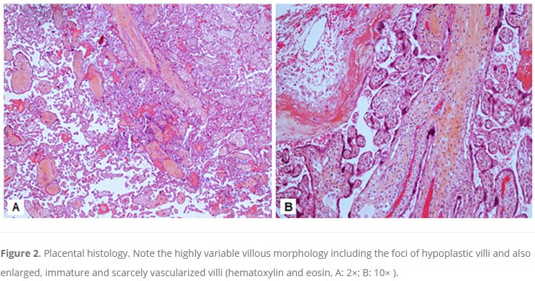 PediDevPath's tweet image. 🚨 New Episode!
Hear @PaedPathSoc President Dr. Jelena Martinovic talk about how perinatal pathology practice informs perinatal counseling in France, and a case of Shwachman-Diamond syndrome presenting as growth restriction.
pedidevpath.podbean.com/e/the-first-fe…
#PediPath