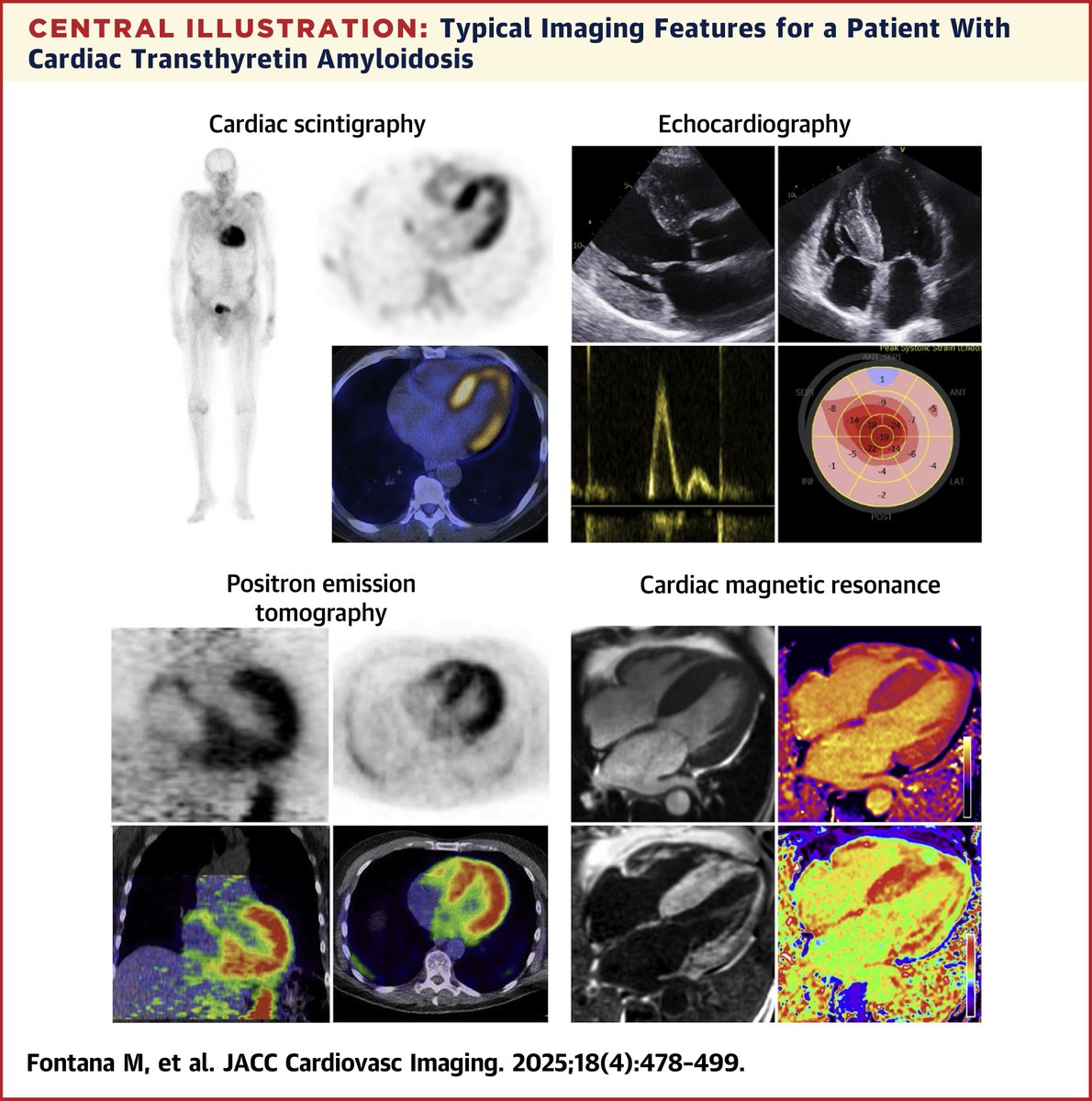 JACC Journals (@jaccjournals) on Twitter photo #JACCIMG state-of-the-art review: How has our understanding of cardiac #amyloidosis changed in the past decade? 🤔
Get the details here: jacc.org/doi/10.1016/j.…
#cvImaging #CardioOnc #CardioX <a href="/DorbalaSharmila/">Sharmila Dorbala</a> <a href="/MicheleEmdin/">Michele Emdin</a> <a href="/SinghVasvi/">Vasvi Singh</a> #JACCIMG state-of-the-art review: How has our understanding of cardiac #amyloidosis changed in the past decade? 🤔
Get the details here: jacc.org/doi/10.1016/j.…
#cvImaging #CardioOnc #CardioX <a href="/DorbalaSharmila/">Sharmila Dorbala</a> <a href="/MicheleEmdin/">Michele Emdin</a> <a href="/SinghVasvi/">Vasvi Singh</a>