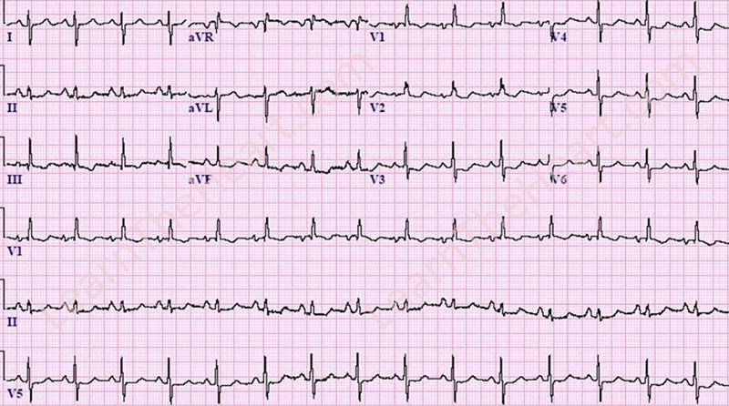 LearntheHeart's tweet photo. #Cardiology #ECGoftheWeek
Which of the following does the ECG represent?
Cast your vote below and check back Monday for the answer! https://t.co/jz24q5Mf74