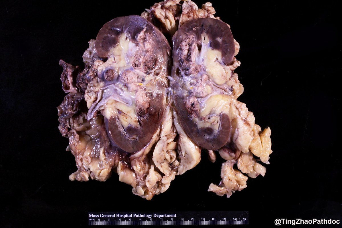 Ting Zhao, MD tweet media