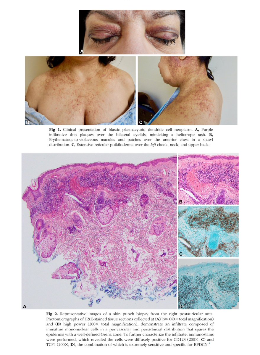 Blastic plasmacytoid dendritic cell neoplasm (BPDCN) is a rare leukemia (0.4 cases per 100,000 individuals) with striking skin predilection: 90% of patients have skin involvement, and 50% have skin-limited disease at presentation. It typically presents with deep purple or
