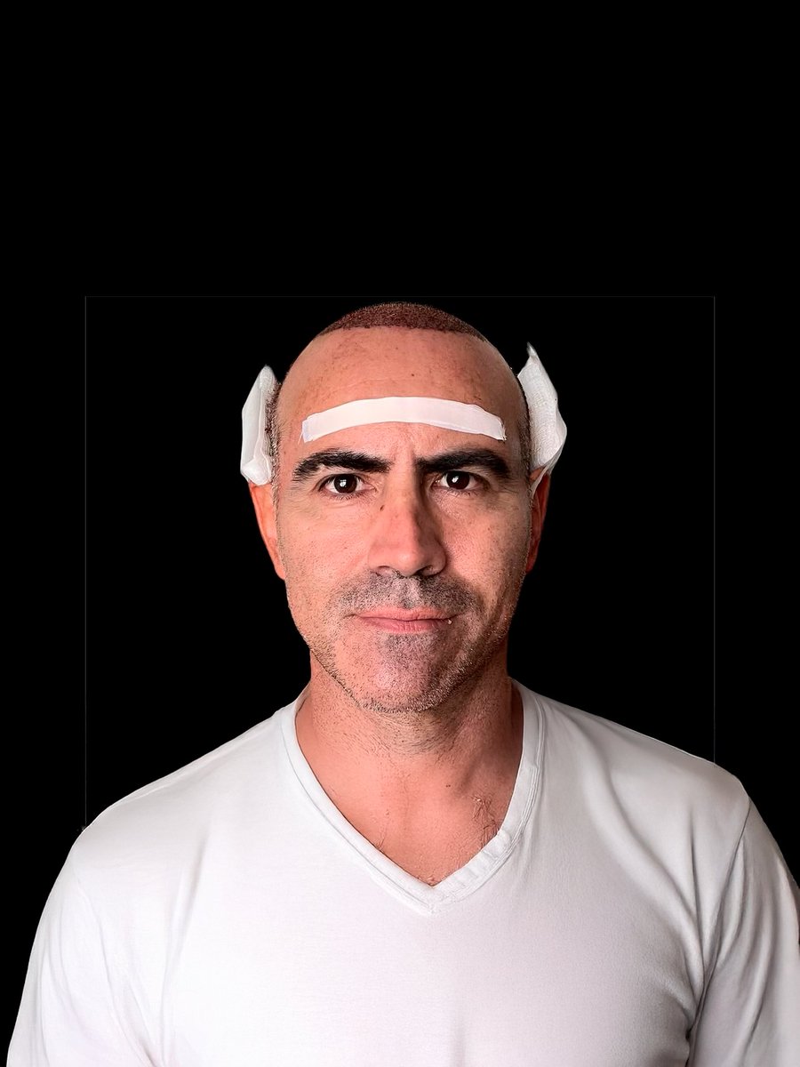 ClinicaDrEO's tweet image. 🧵¿Te has preguntado para qué sirve la cinta en la frente después del trasplante capilar? 🤔 ¡Es clave para tu recuperación!👇 #TrasplanteCapilar #Postoperatorio #clinicadreo