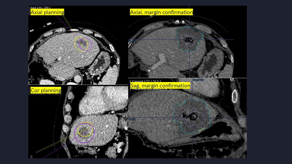 Zach Berman MD (@ztberman) on Twitter photo Coming off of a great SIR, presenting our robotic ablation experience, here is a nice robotic MWA case for two obliquely placed probes covering an irregular CRC met with margin confirmation. <a href="/ucsd_ir/">UC San Diego Interventional Radiology</a> <a href="/SIRspecialists/">Society of Interventional Radiology</a> <a href="/SIO_Central/">SIO</a> <a href="/QuantumSurgical/">Quantum Surgical</a> <a href="/_backtable/">BackTable Vascular and Interventional</a> <a href="/_backtableONC/">BackTable Tumor Board</a> Coming off of a great SIR, presenting our robotic ablation experience, here is a nice robotic MWA case for two obliquely placed probes covering an irregular CRC met with margin confirmation. <a href="/ucsd_ir/">UC San Diego Interventional Radiology</a> <a href="/SIRspecialists/">Society of Interventional Radiology</a> <a href="/SIO_Central/">SIO</a> <a href="/QuantumSurgical/">Quantum Surgical</a> <a href="/_backtable/">BackTable Vascular and Interventional</a> <a href="/_backtableONC/">BackTable Tumor Board</a>