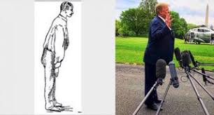 peterproctor's tweet photo. @RonFilipkowski Frontal-Temporal Dementia (FTD)   R/O Parkinsons dementia.  The frontal lean is pathognomic (names the disease). https://t.co/AXNQWMrl3T